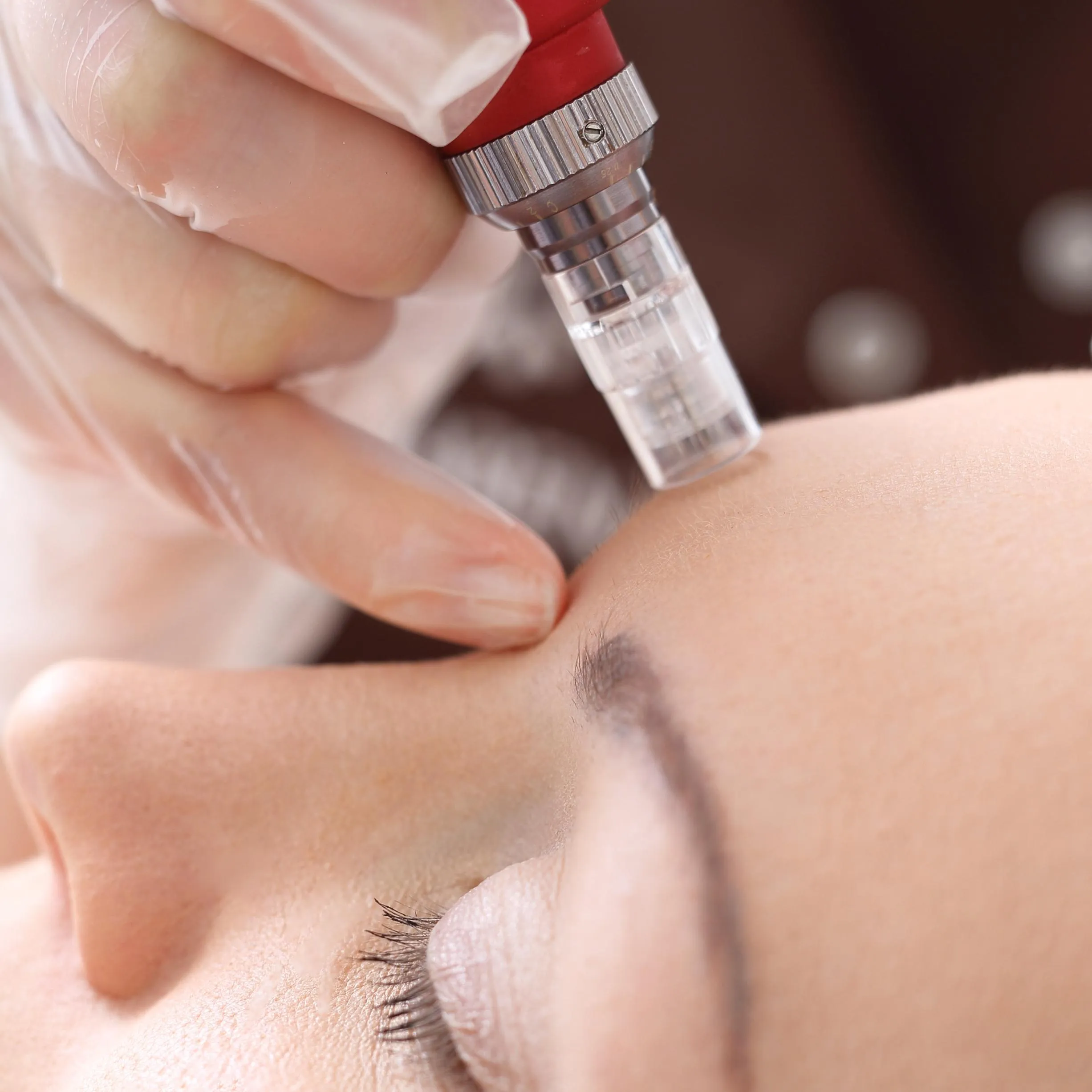 Microneedling